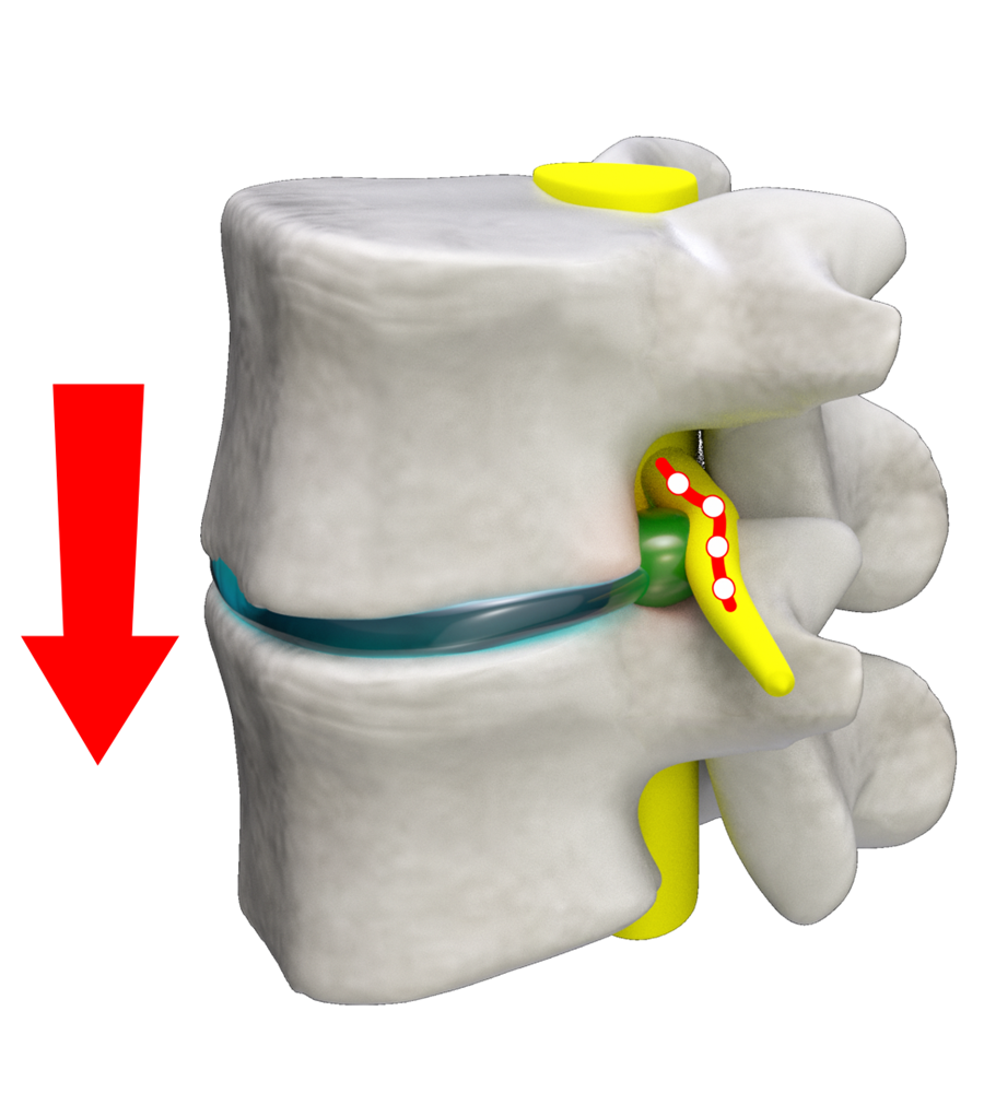 Spinal Stenosis